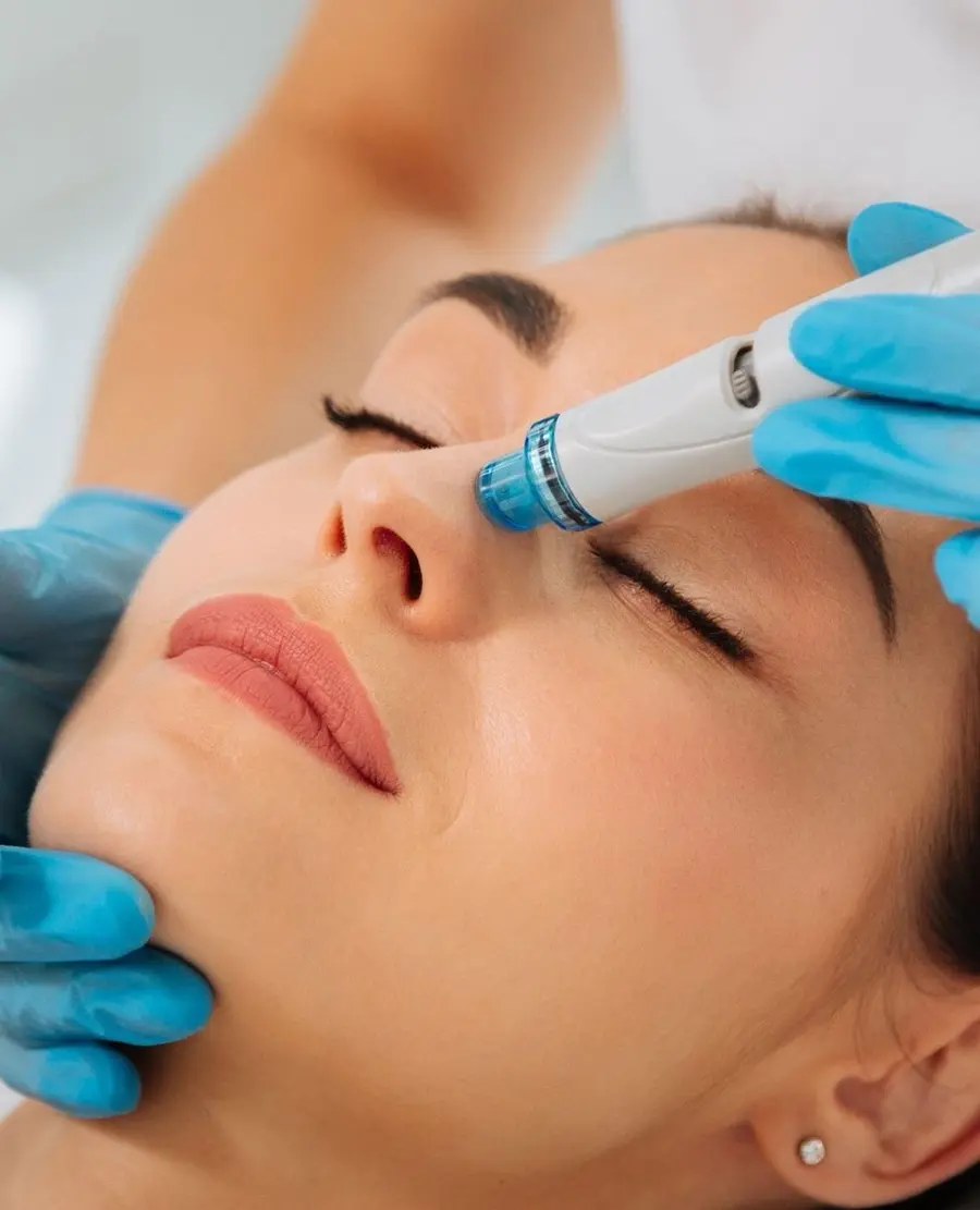 Professionelle Microneedling-Behandlung im Gesicht